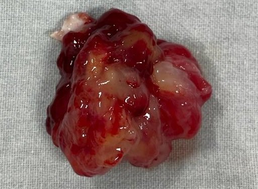 Large La Myxoma In Young Stroke Patient Treated Surgically